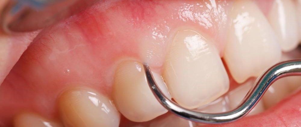 علت سفید شدن لثه‌ها